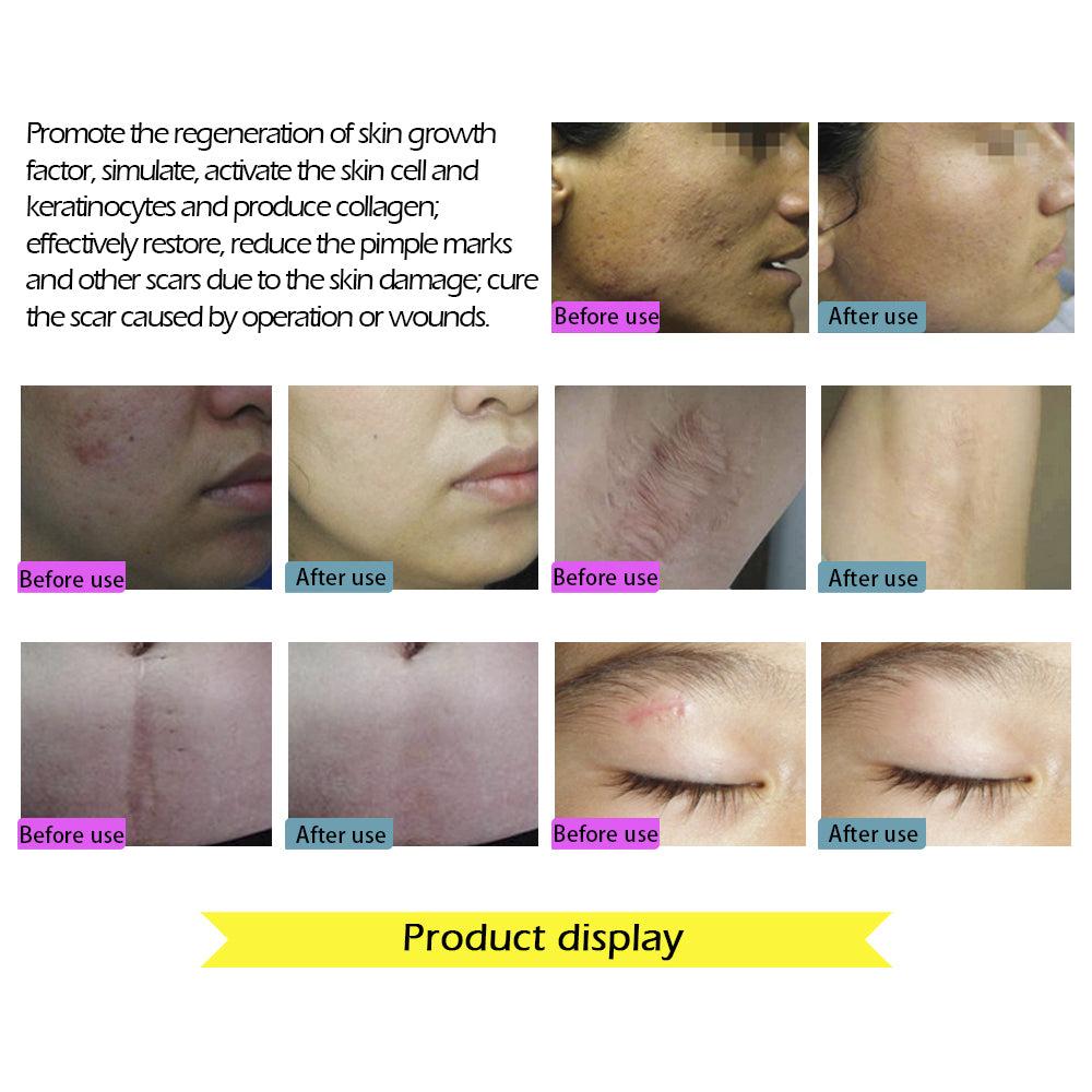 Acne and Scar Removal Cream for Clearer Skin by HitMyNeed