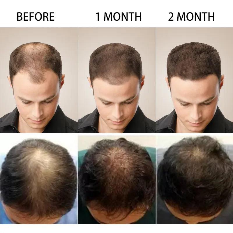 Herbal Hair Growth Oil for Thinning Hair 20ml by HitMyNeed