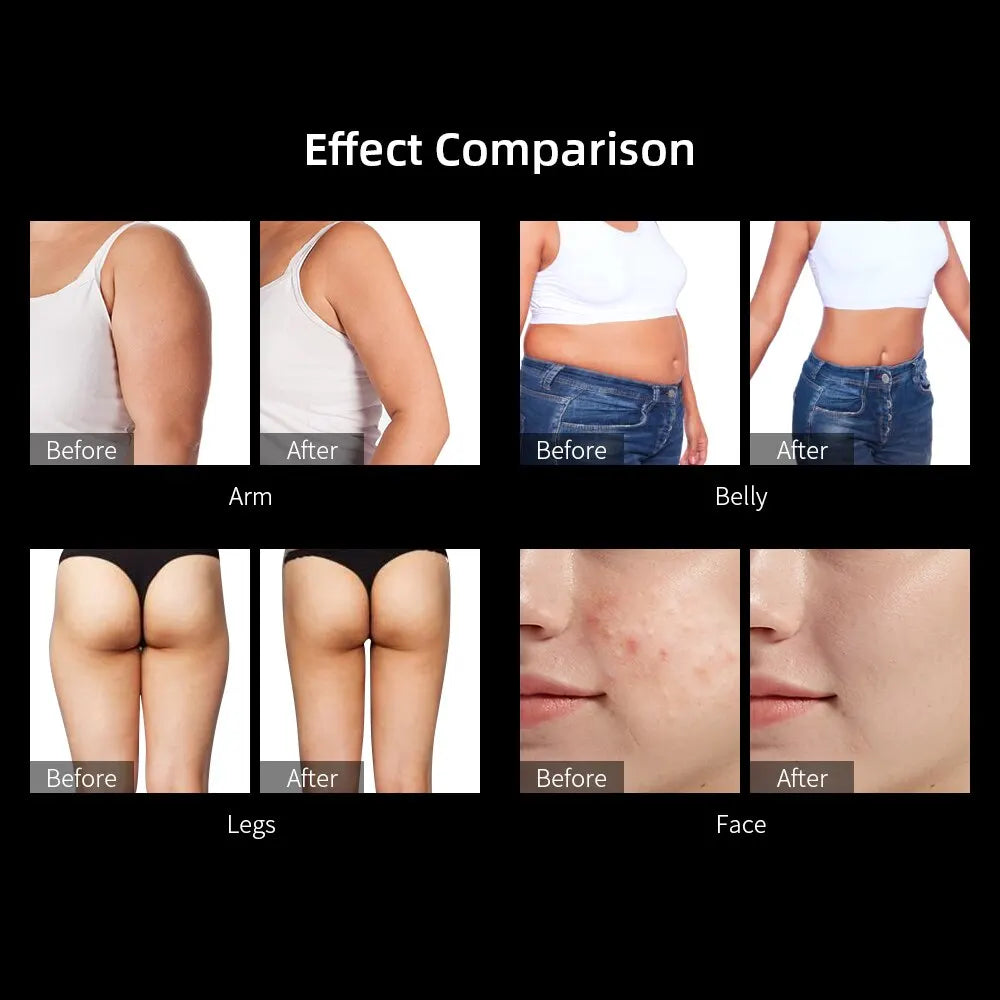 40K 3-in-1 Cavitation RF Body & Face Slimming Device by HitMyNeed