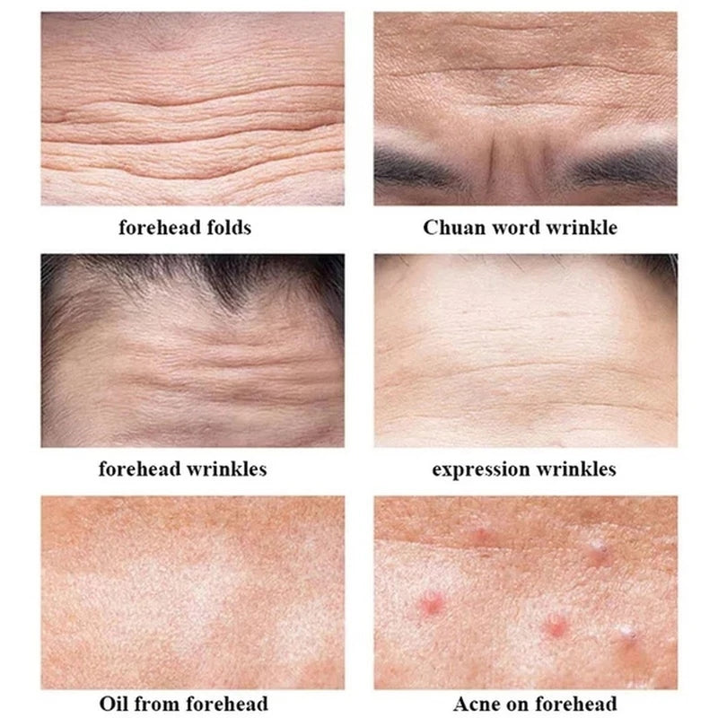 6pcs Forehead Anti-Wrinkle Gel Patches by HitMyNeed