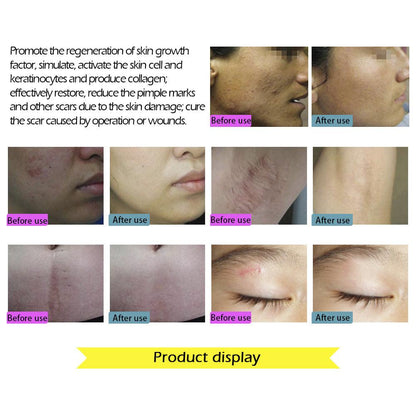 Acne and Scar Removal Cream for Clearer Skin by HitMyNeed