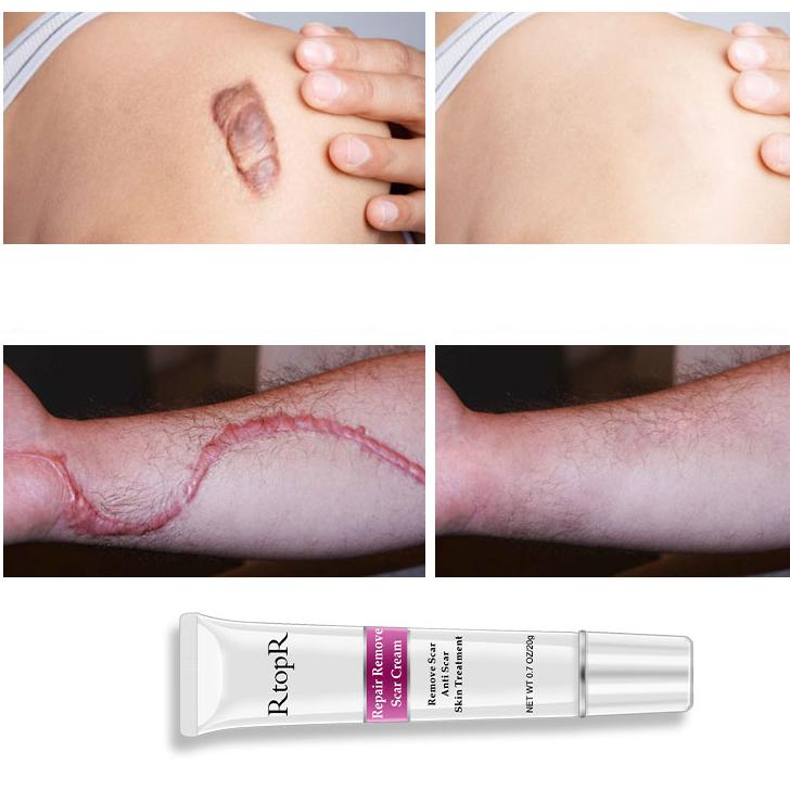 Acne Scar Cream for Dark Spots & Skin Repair 20g by HitMyNeed