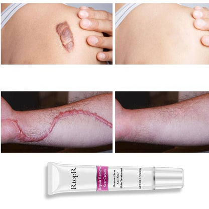 Acne Scar Cream for Dark Spots & Skin Repair 20g by HitMyNeed