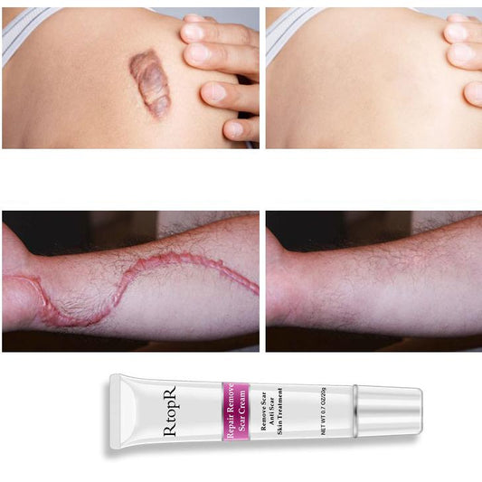 Acne Scar Cream for Dark Spots & Skin Repair 20g by HitMyNeed