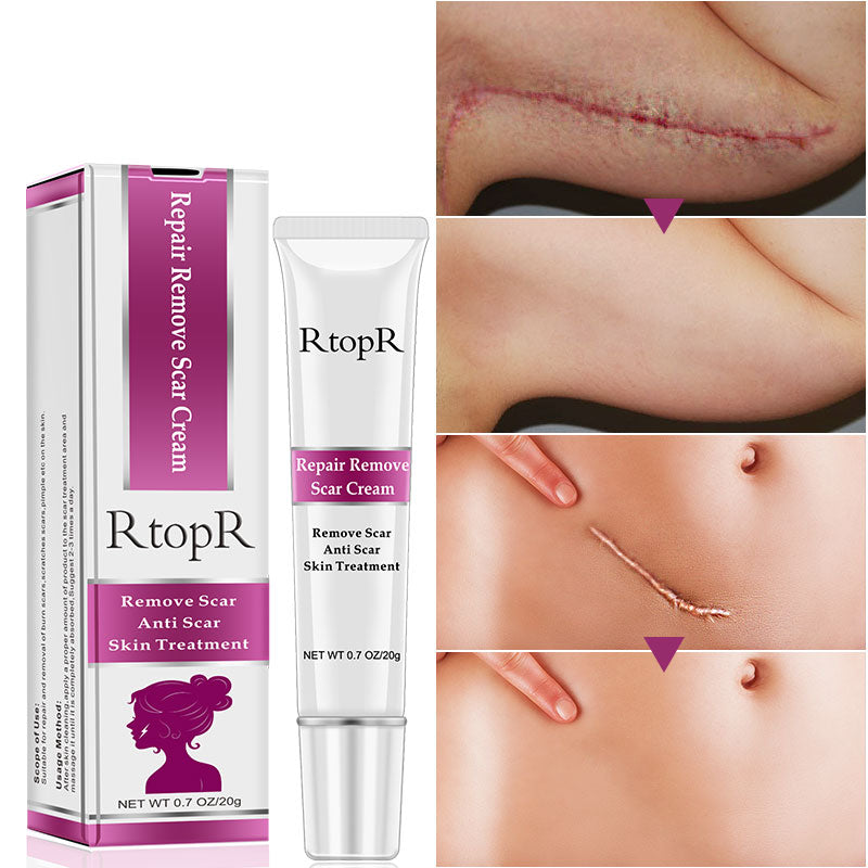 Acne Scar Cream for Dark Spots & Skin Repair 20g by HitMyNeed