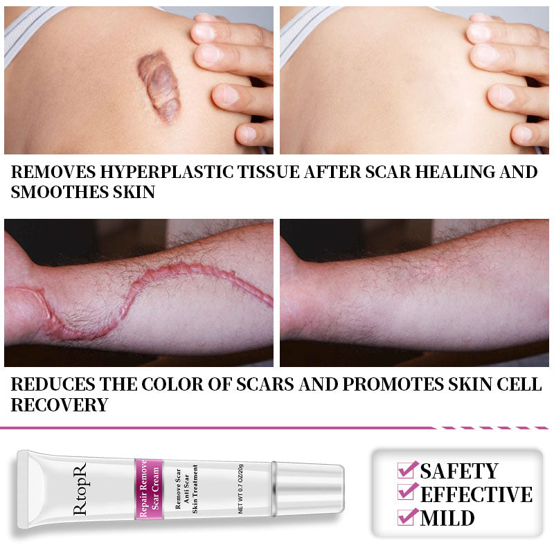 Acne Scar Cream for Dark Spots & Skin Repair 20g by HitMyNeed