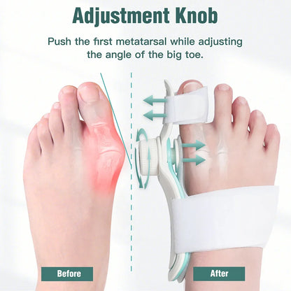 Adjustable Bunion Corrector with 3-Angle Hallux Valgus Support by HitMyNeed