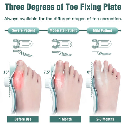 Adjustable Bunion Corrector with 3-Angle Hallux Valgus Support by HitMyNeed