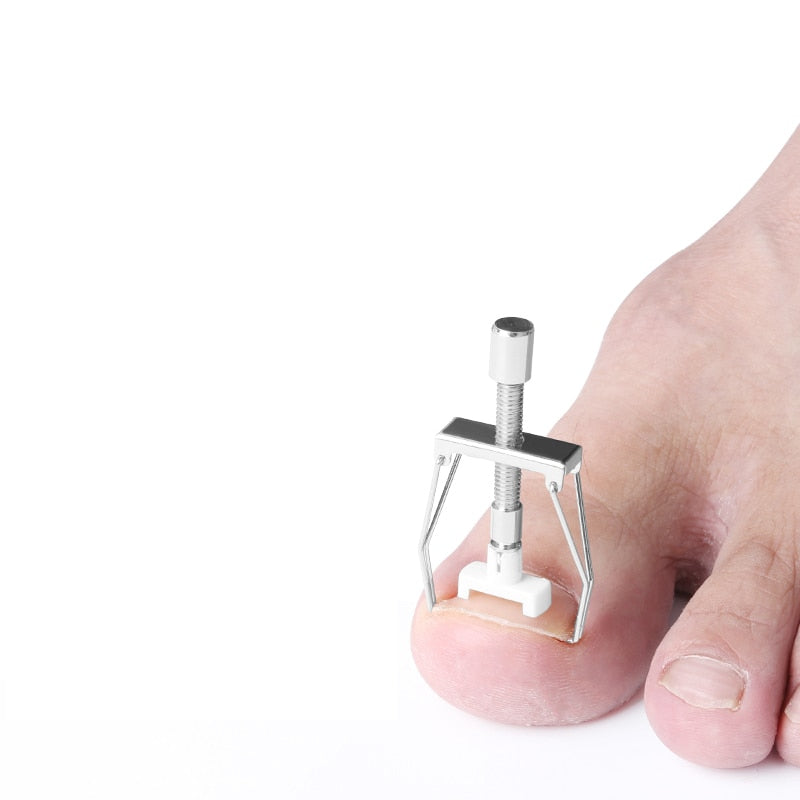 Adjustable Ingrown Toenail Corrector Tool Set by HitMyNeed