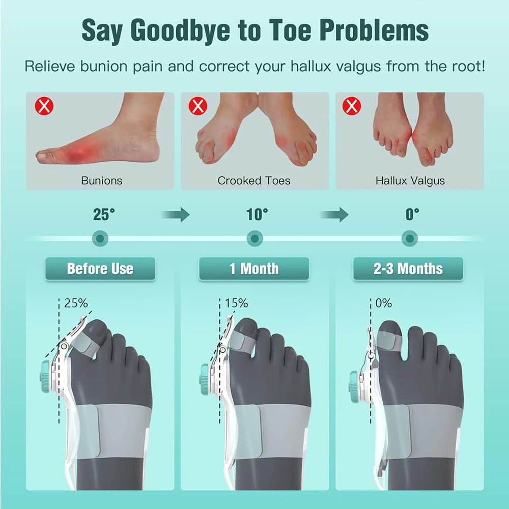 Adjustable Rotating Bunion Corrector for Hallux Valgus by HitMyNeed