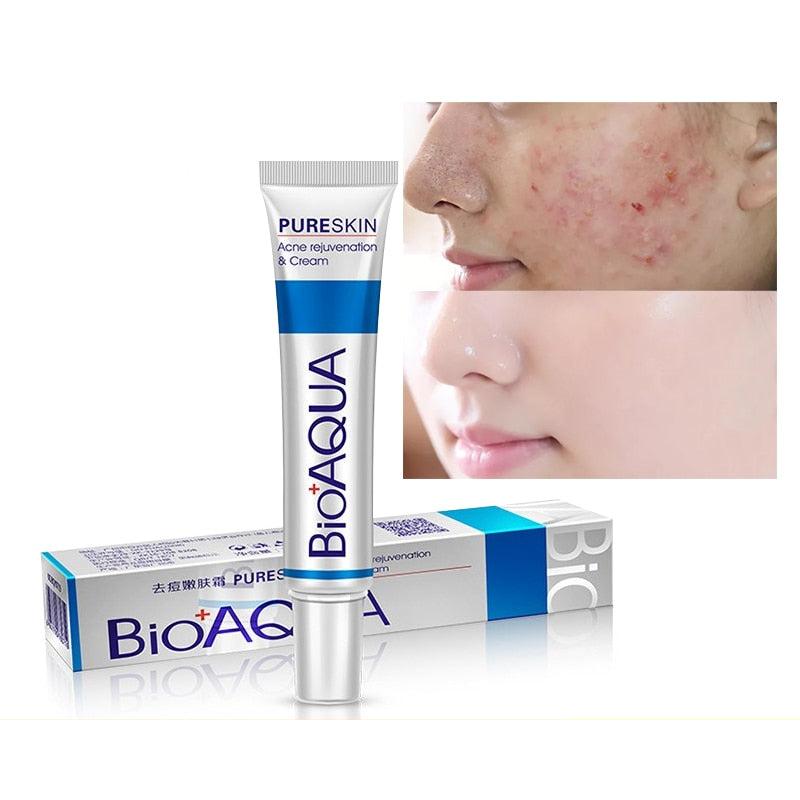BioAqua Acne Treatment Skin Healer Cream 30g by HitMyNeed
