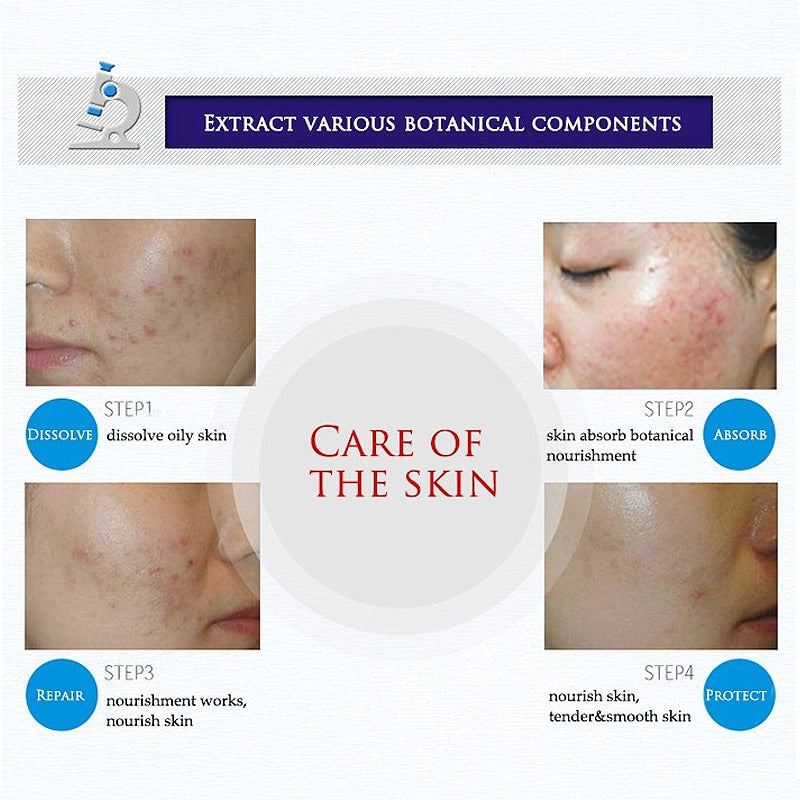BioAqua Acne Treatment Skin Healer Cream 30g by HitMyNeed