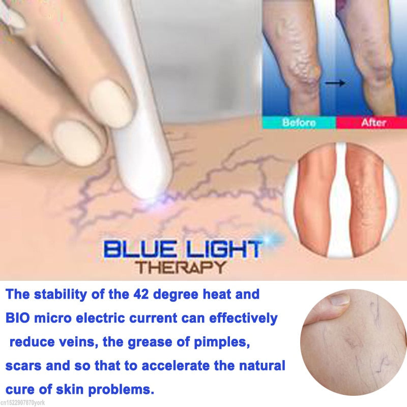 Blue Light Therapy Pen with Vein Care Cream by HitMyNeed