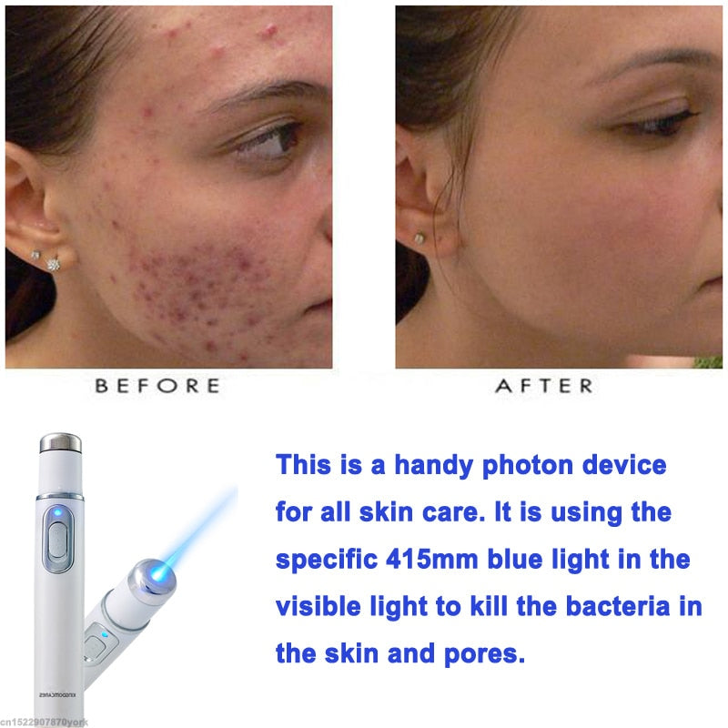 Blue Light Therapy Pen with Vein Care Cream by HitMyNeed