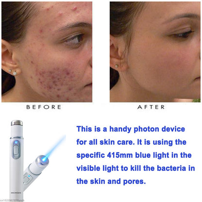 Blue Light Therapy Pen with Vein Care Cream by HitMyNeed