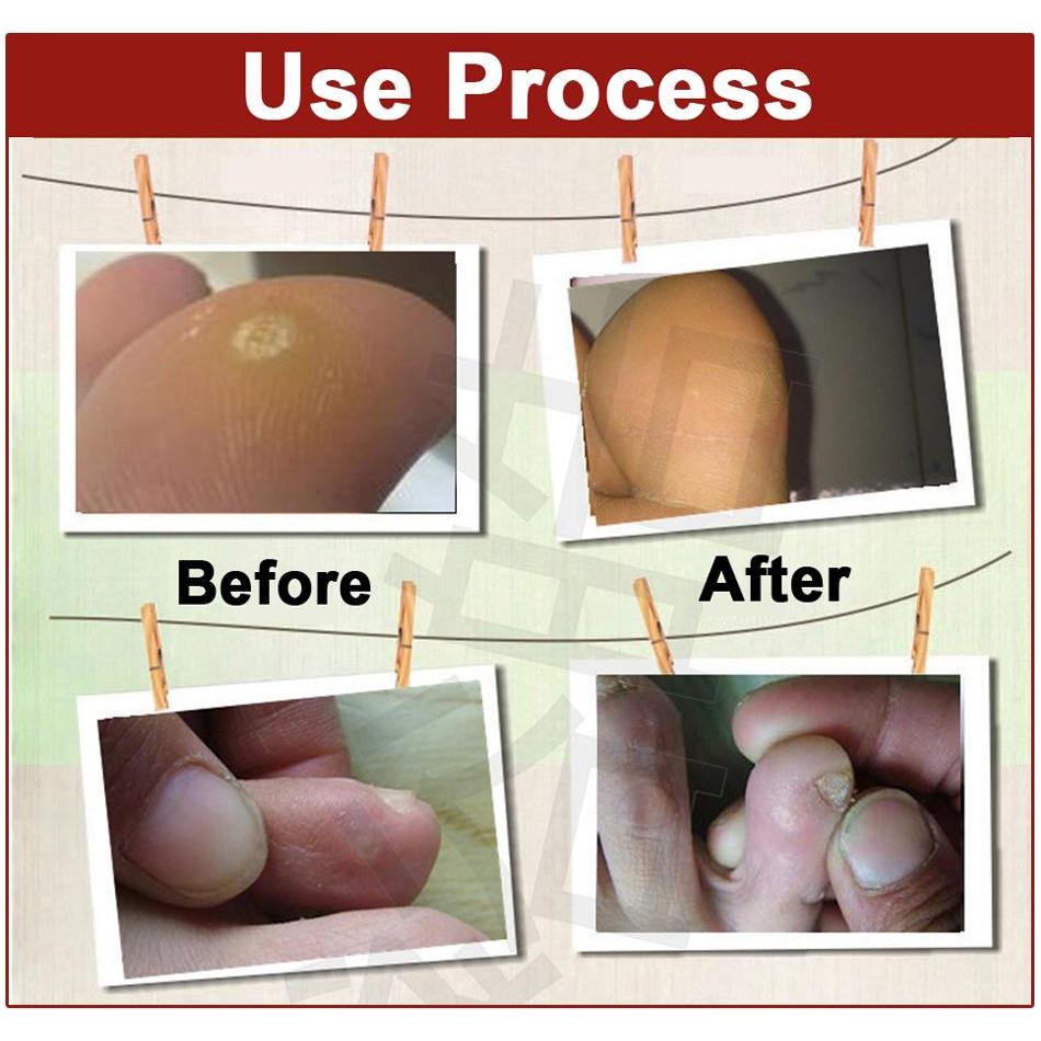 Corn Removal Plasters with Salicylic Acid (40 Pack) by HitMyNeed