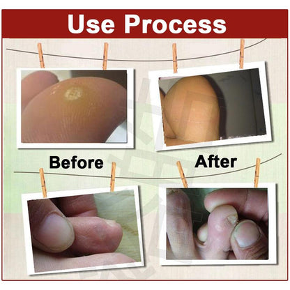 Corn Removal Plasters with Salicylic Acid (40 Pack) by HitMyNeed