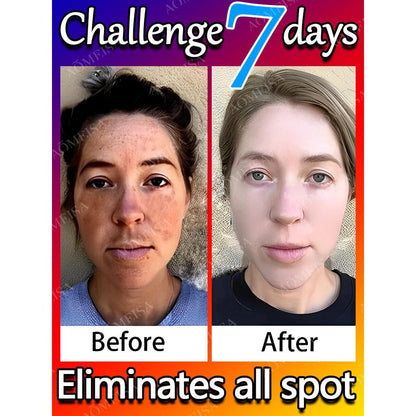 Dark Spot & Freckle Correcting Brightening Cream by HitMyNeed