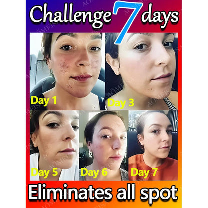 Dark Spot & Freckle Correcting Brightening Cream by HitMyNeed