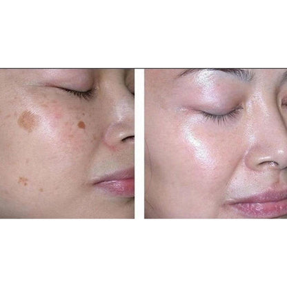 Dark Spot & Freckle Correcting Brightening Cream Pack of 5 by HitMyNeed