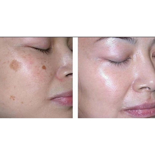 Dark Spot & Freckle Correcting Brightening Cream Pack of 5 by HitMyNeed