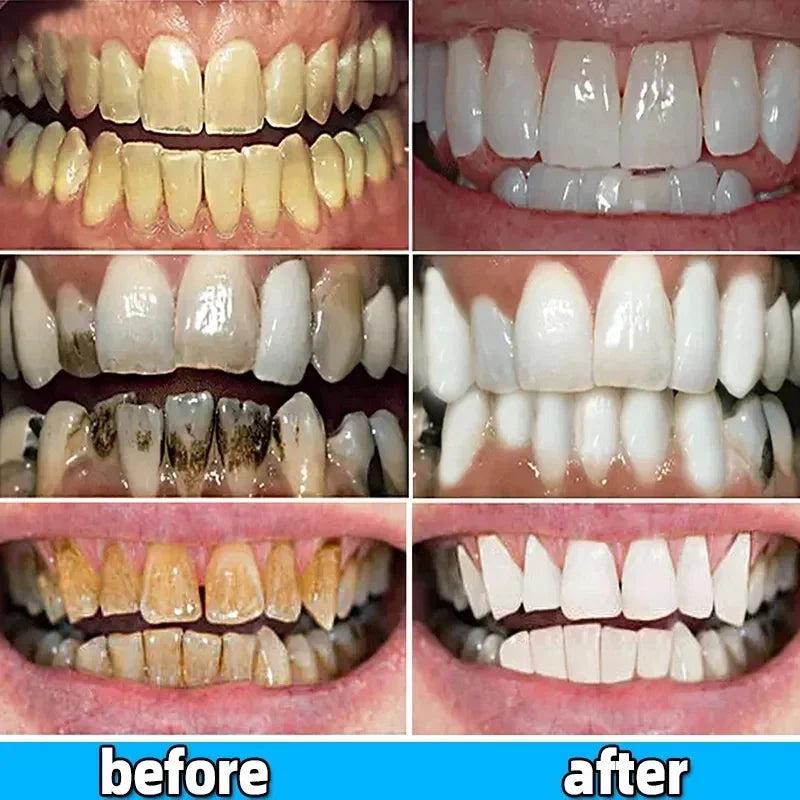 Dental Calculus Remover & Whitening Toothpaste 100g by HitMyNeed