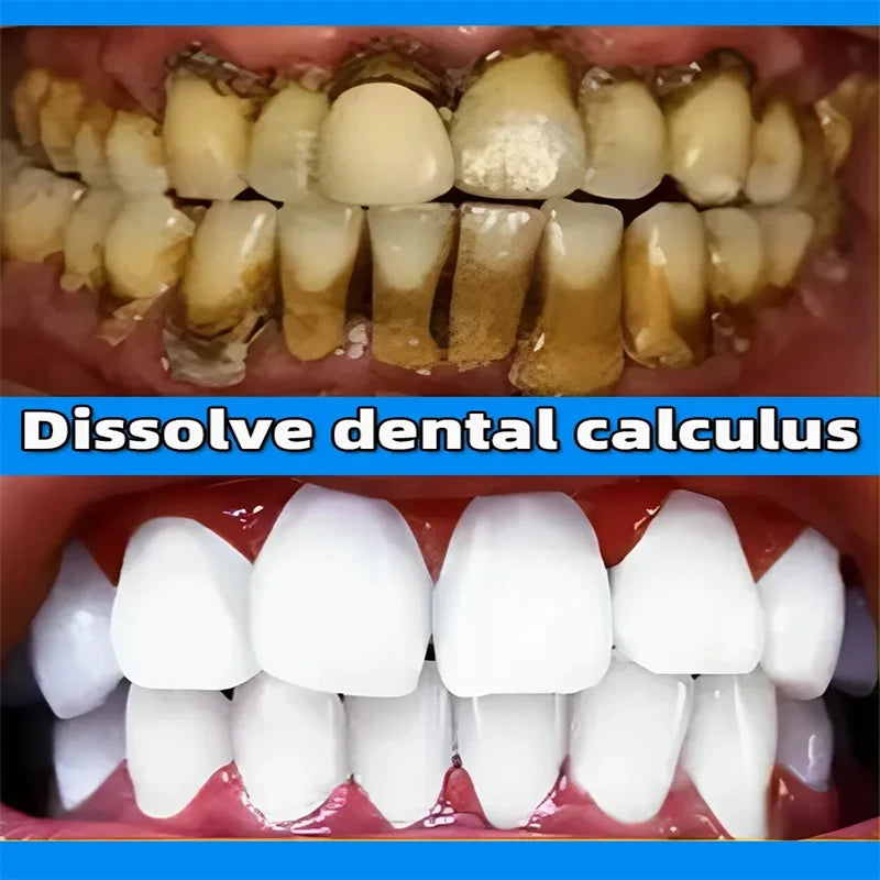 Dental Calculus Remover & Whitening Toothpaste 100g by HitMyNeed