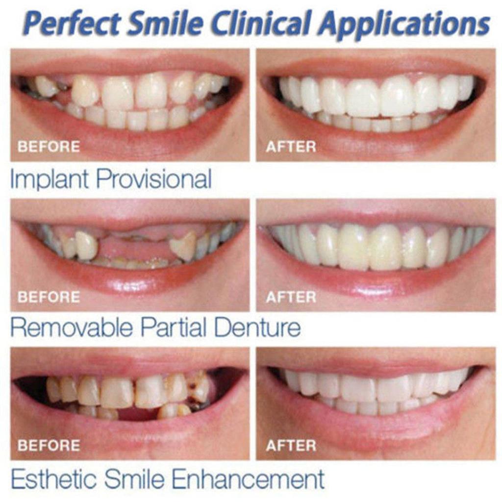 Dental Veneers Teeth Caps - Temporary Cosmetic Cover by HitMyNeed