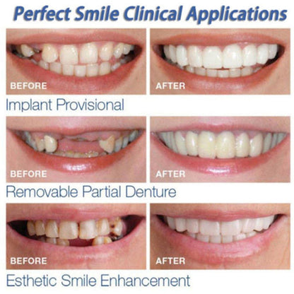 Dental Veneers Teeth Caps - Temporary Cosmetic Cover by HitMyNeed