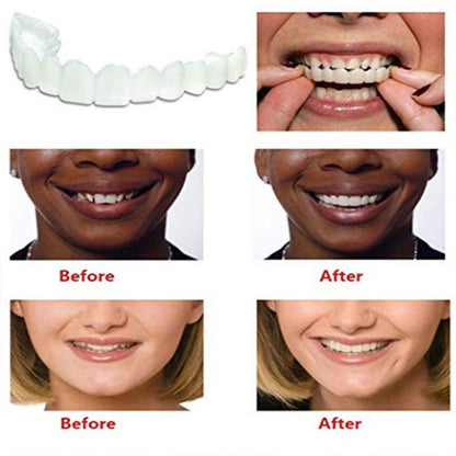 Dental Veneers Teeth Caps - Temporary Cosmetic Cover by HitMyNeed