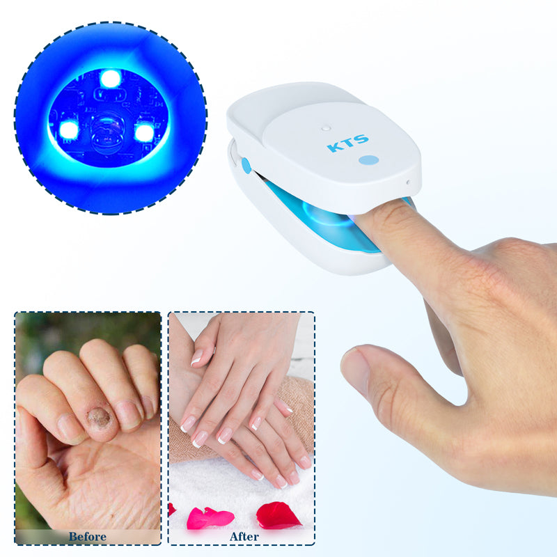 Fungal Nail Laser Treatment Device 905nm & 470nm by HitMyNeed
