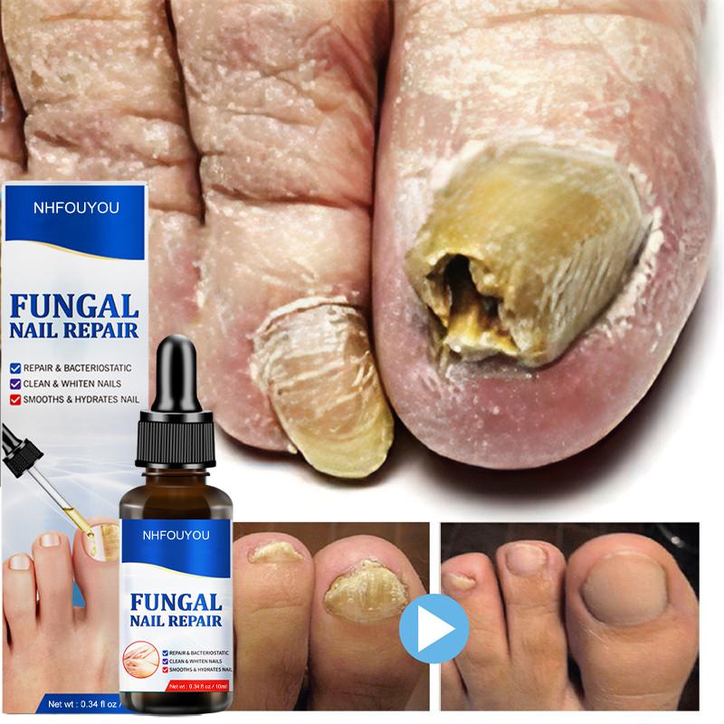 Fungal Nail Treatment Oil 10ml Foot Repair Essence by HitMyNeed