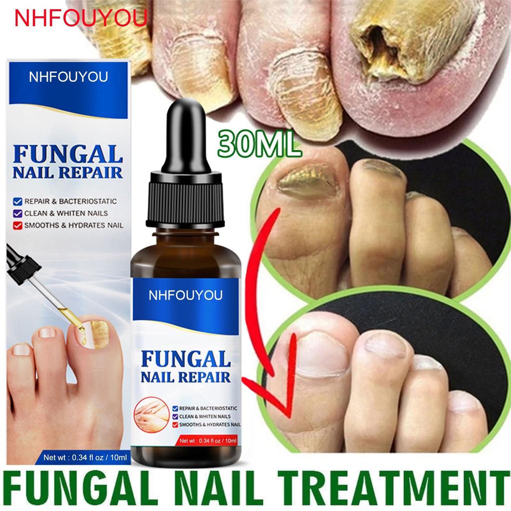 Fungal Nail Treatment Oil 10ml Foot Repair Essence by HitMyNeed