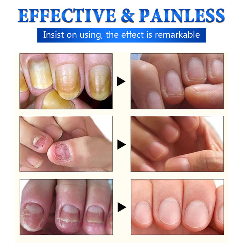 Fungal Nail Treatment Oil 10ml Foot Repair Essence by HitMyNeed