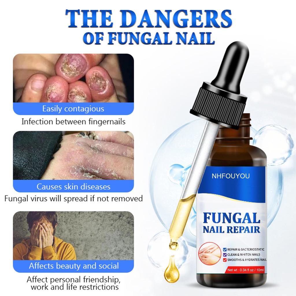 Fungal Nail Treatment Oil 10ml Foot Repair Essence by HitMyNeed