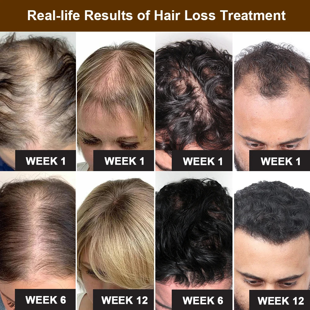 Ginger & Ginseng Hair Regrowth Roller Serum 20g by HitMyNeed