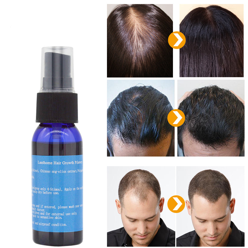 Hair Regrowth Tonic for Thinning Hair & Dandruff by HitMyNeed
