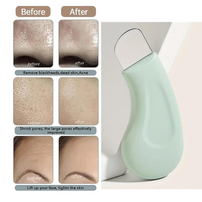 Handheld Blackhead Remover for Nose & Face Care by HitMyNeed