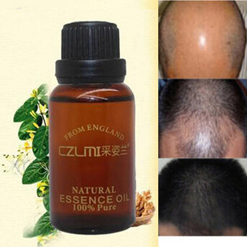 Herbal Alopecia Hair Loss Treatment Oil 10ml by HitMyNeed