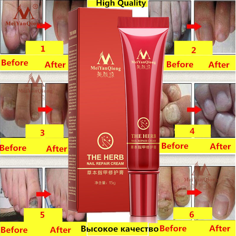 Herbal Antifungal Nail Treatment Cream 15g by HitMyNeed