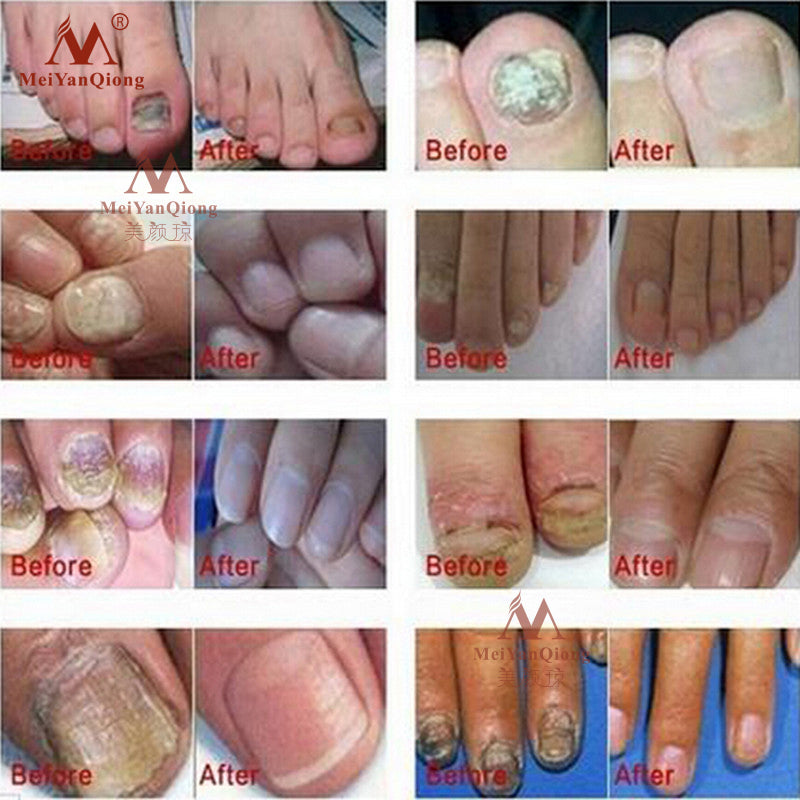 Herbal Antifungal Nail Treatment Cream 15g by HitMyNeed