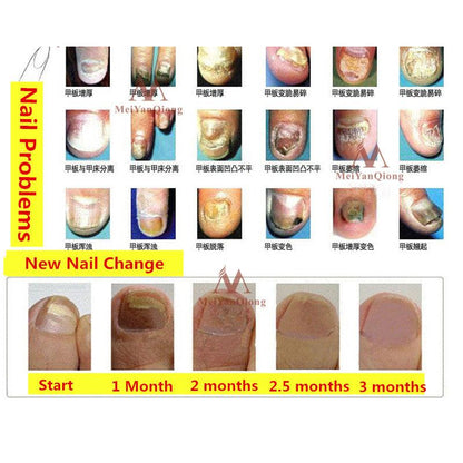 Herbal Antifungal Nail Treatment Cream 15g by HitMyNeed