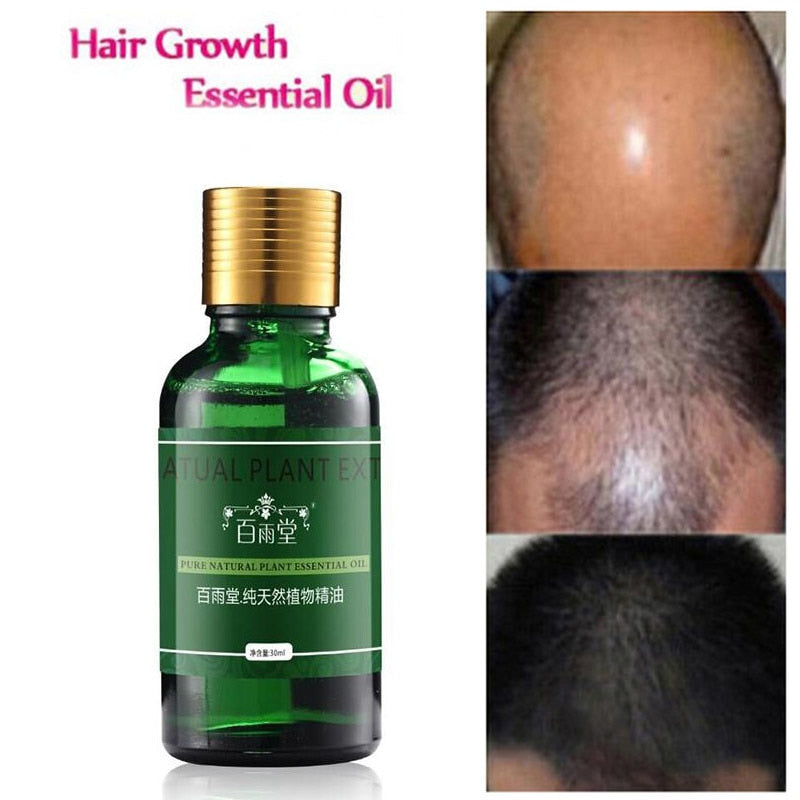 Herbal Hair Growth & Scalp Treatment Oil 30ml by HitMyNeed