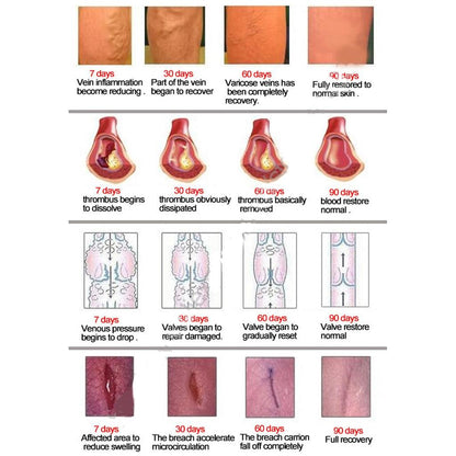 Herbal Varicose Vein Relief Cream 30ml by HitMyNeed