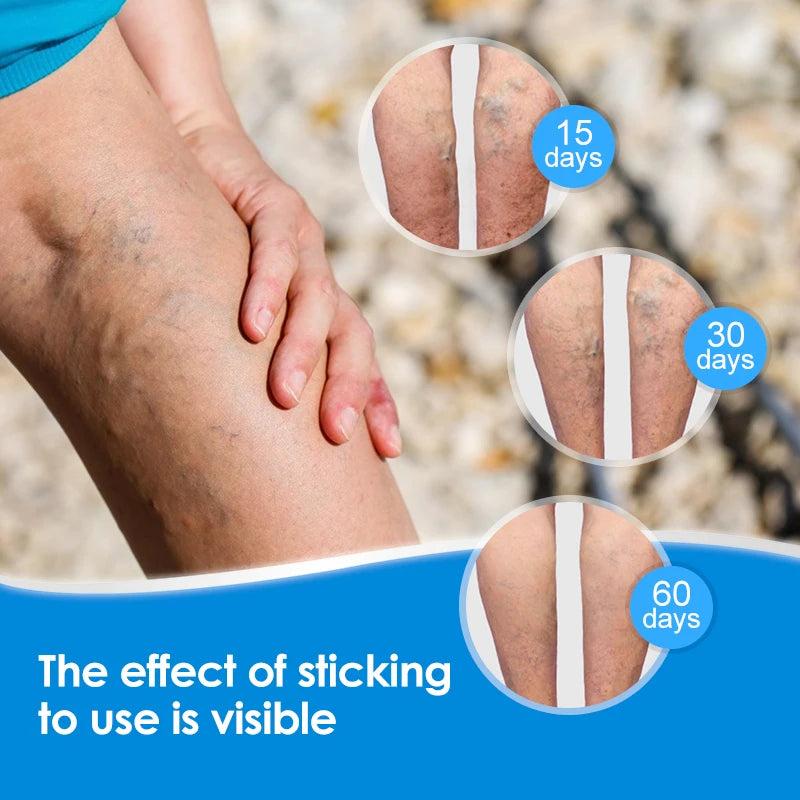 Herbal Varicose Vein Relief Patches by HitMyNeed