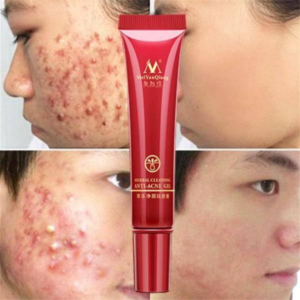 Acne Scar Vanish Cream