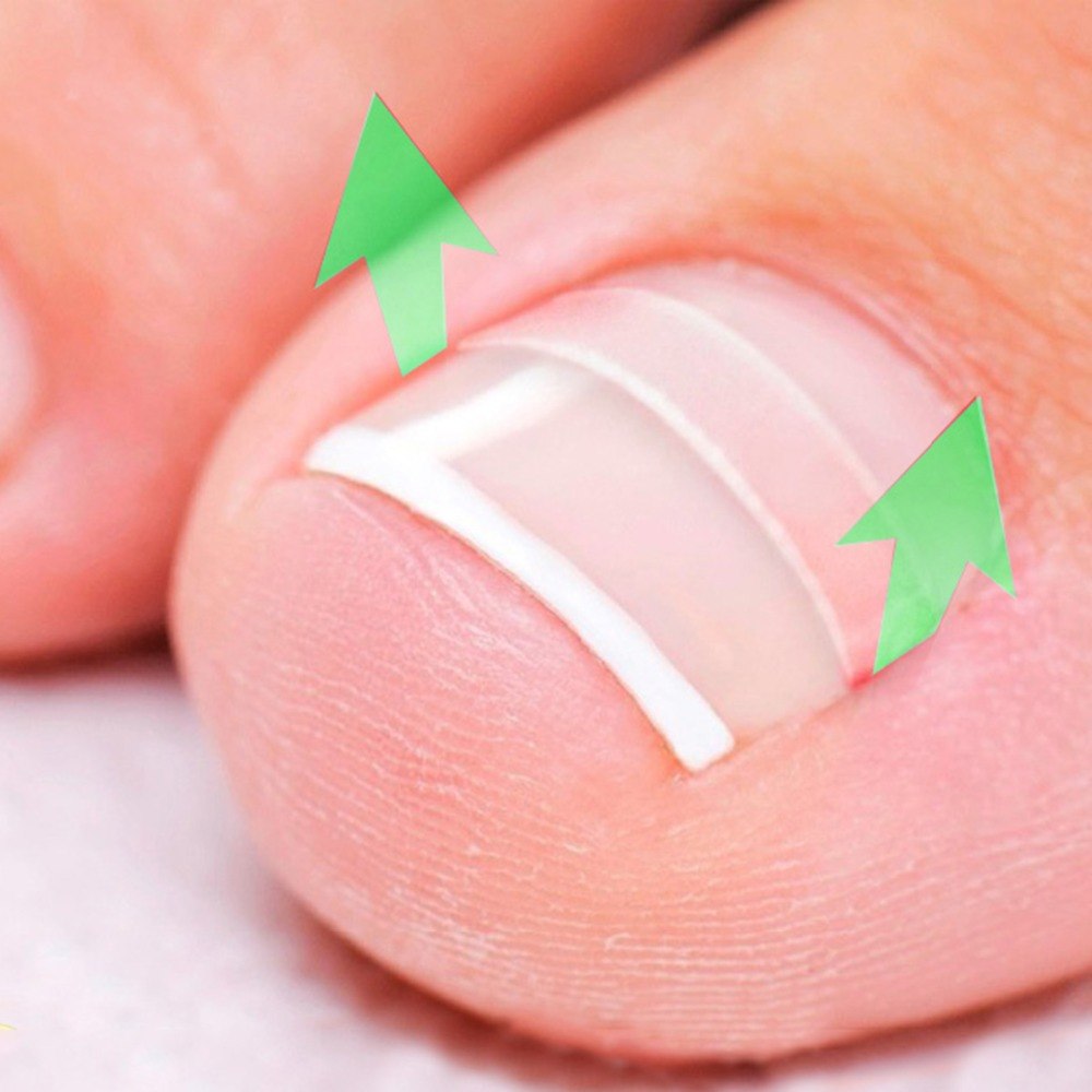 Ingrown Toenail Correction and Care Set by HitMyNeed