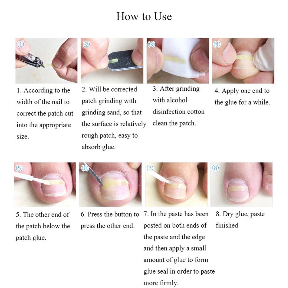Ingrown Toenail Correction and Care Set by HitMyNeed