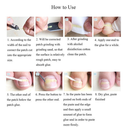 Ingrown Toenail Correction and Care Set by HitMyNeed