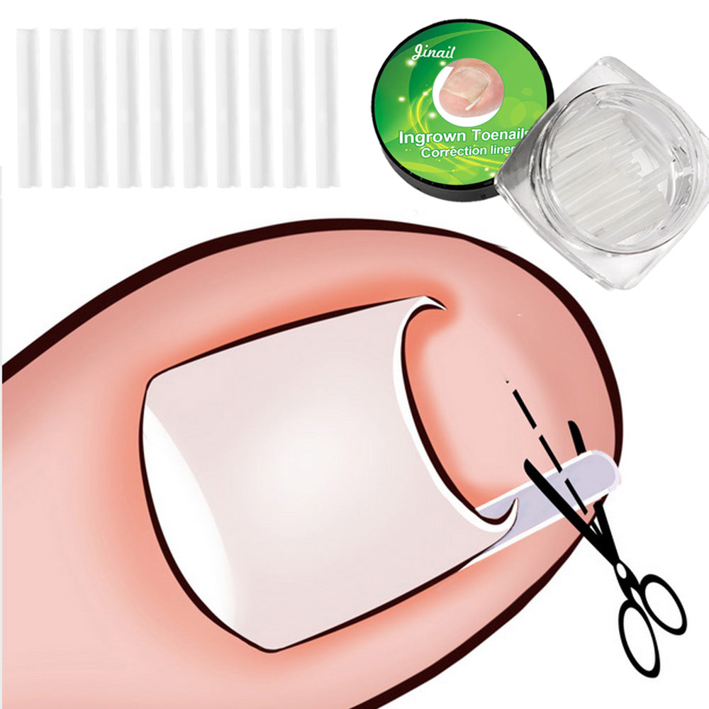 Ingrown Toenail Correction Elastic Patch Set, 10pcs by HitMyNeed